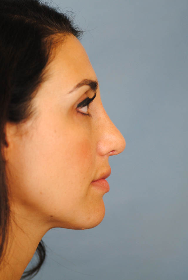 Rhinoplasty Before and After | Thomas Funcik MD