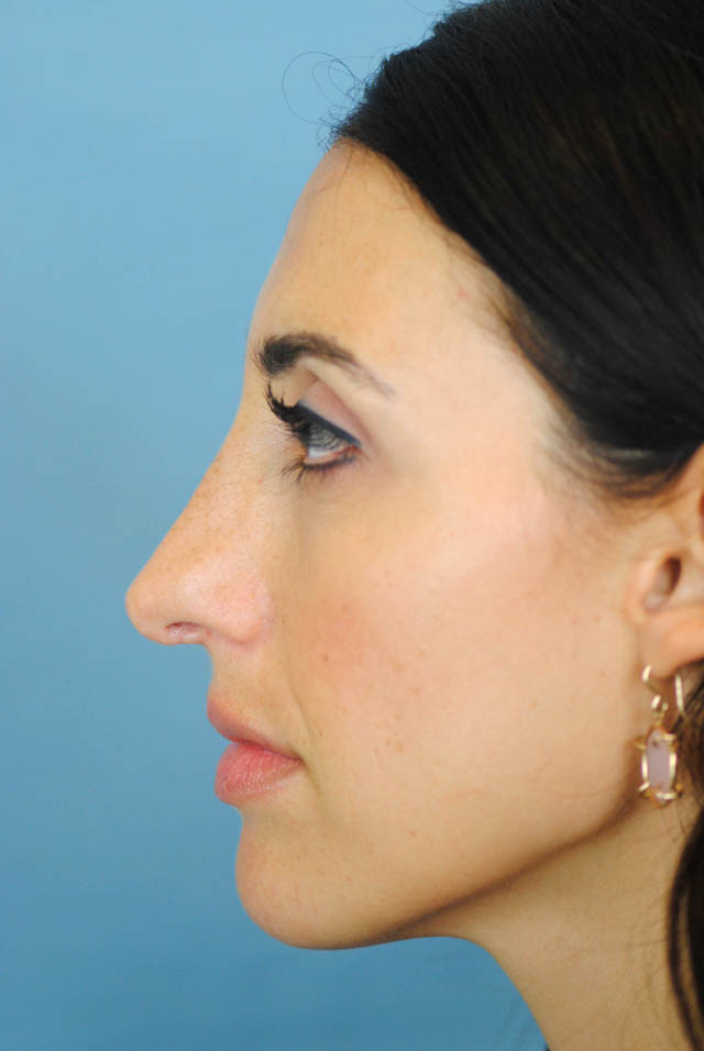 Rhinoplasty Before and After | Thomas Funcik MD