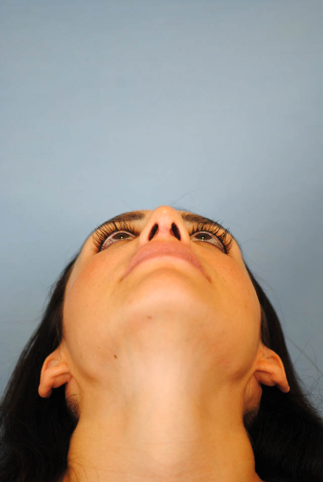 Rhinoplasty Before and After | Thomas Funcik MD