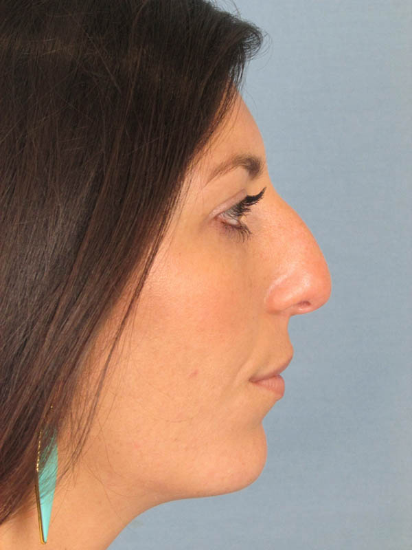 Rhinoplasty Before and After | Thomas Funcik MD