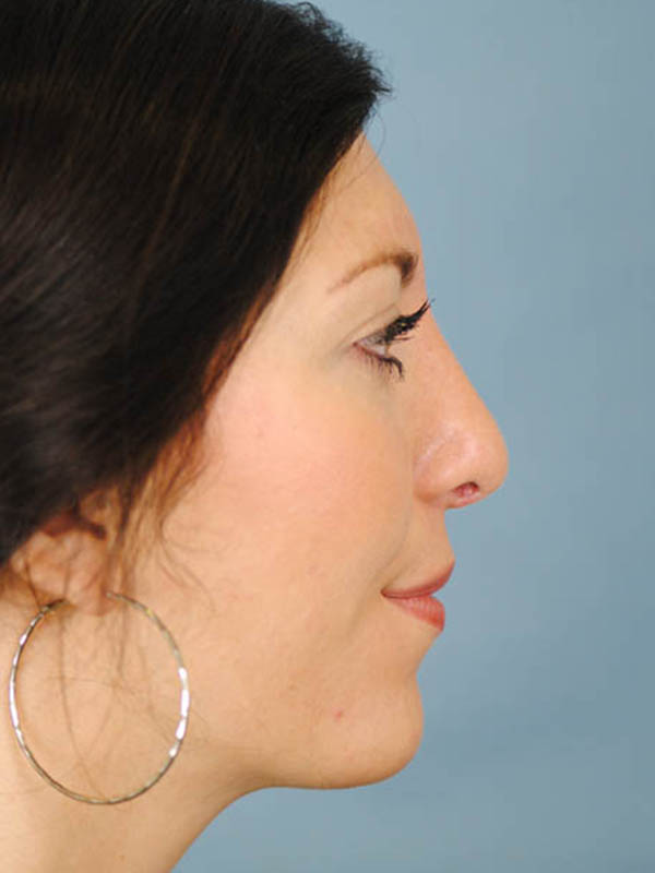 Rhinoplasty Before and After | Thomas Funcik MD