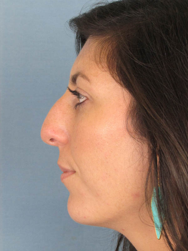 Rhinoplasty Before and After | Thomas Funcik MD