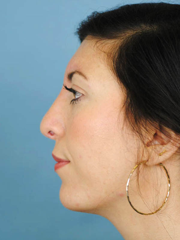 Rhinoplasty Before and After | Thomas Funcik MD