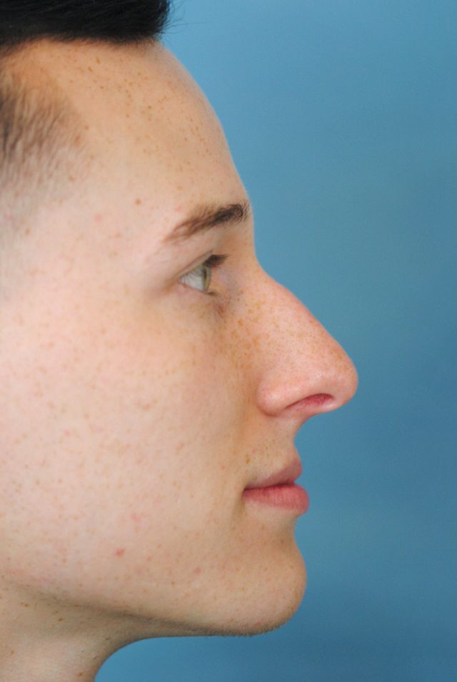 Rhinoplasty Before and After | Thomas Funcik MD