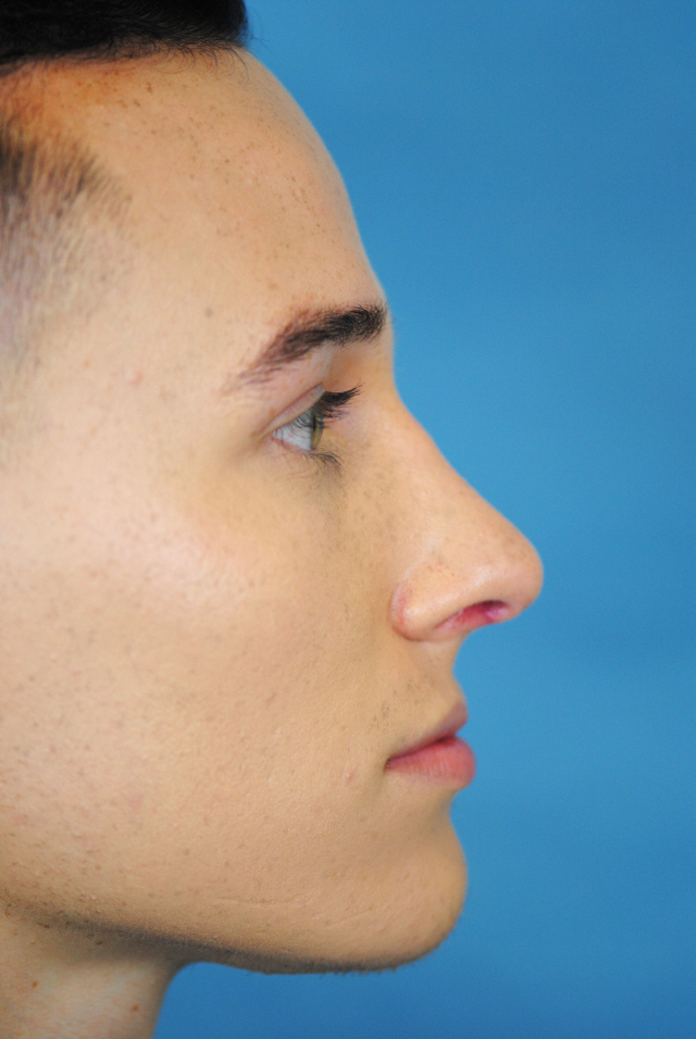 Rhinoplasty Before and After | Thomas Funcik MD