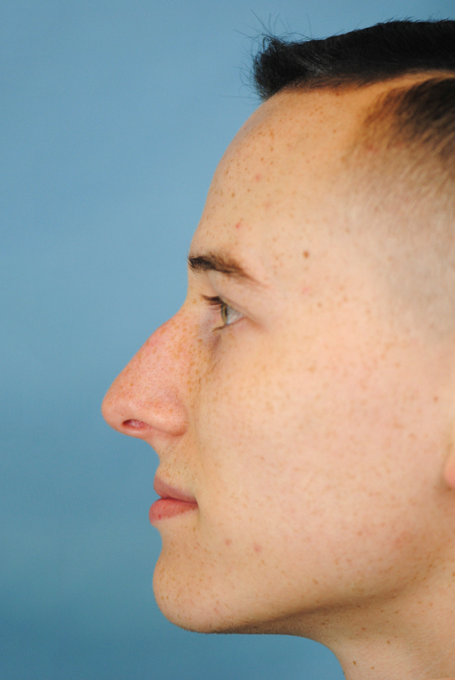 Rhinoplasty Before and After | Thomas Funcik MD