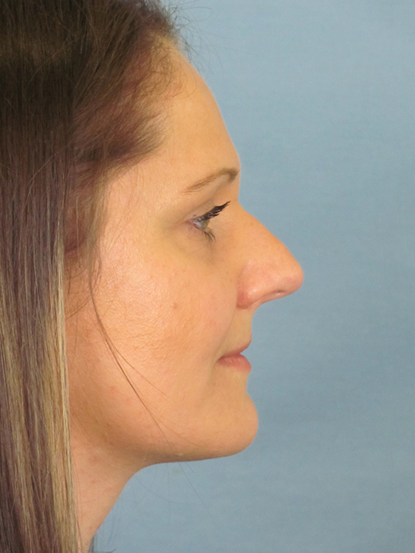 Rhinoplasty Before and After | Thomas Funcik MD