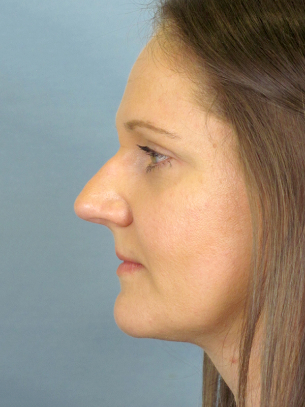 Rhinoplasty Before and After | Thomas Funcik MD