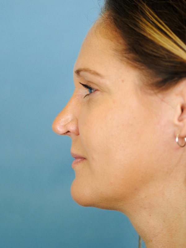 Rhinoplasty Before and After | Thomas Funcik MD