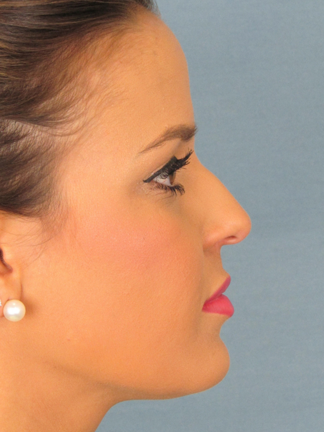 Rhinoplasty Before and After | Thomas Funcik MD