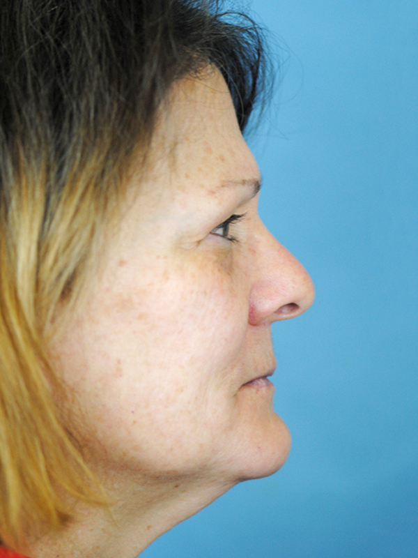 Rhinoplasty Before and After | Thomas Funcik MD