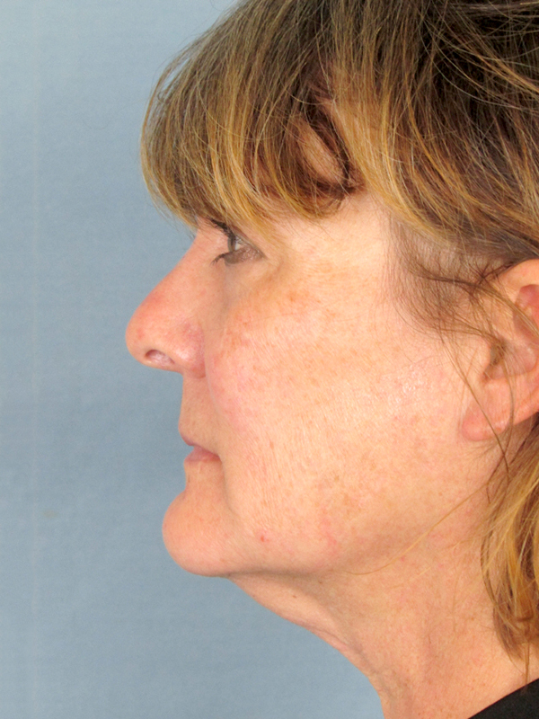 Rhinoplasty Before and After | Thomas Funcik MD