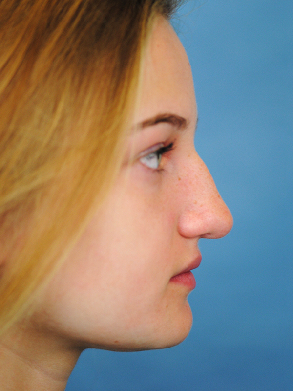 Rhinoplasty Before and After | Thomas Funcik MD