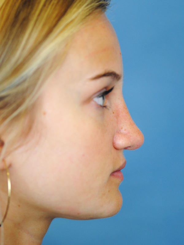 Rhinoplasty Before and After | Thomas Funcik MD