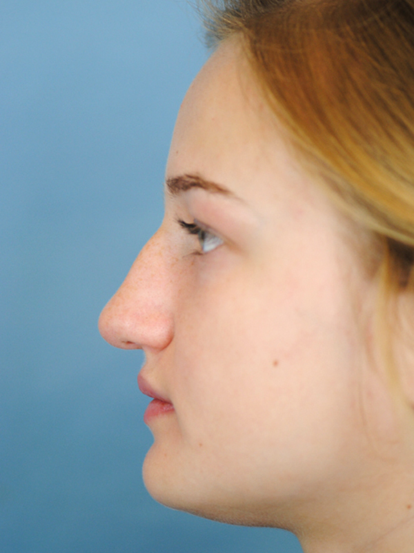 Rhinoplasty Before and After | Thomas Funcik MD