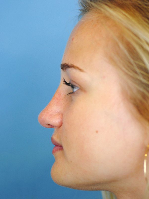 Rhinoplasty Before and After | Thomas Funcik MD