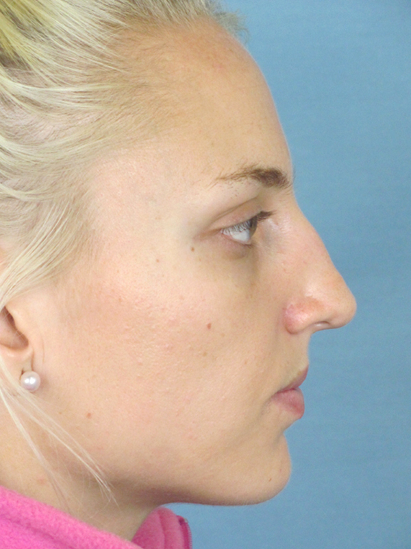 Rhinoplasty Before and After | Thomas Funcik MD