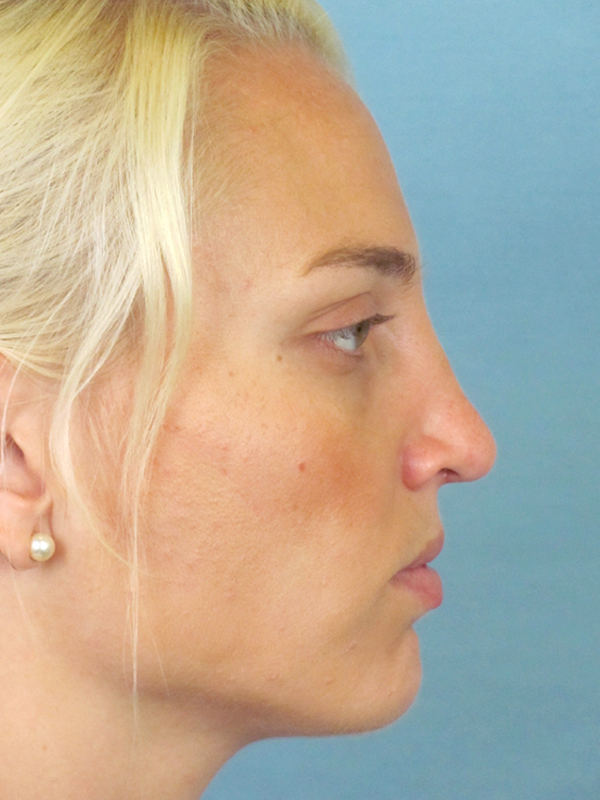 Rhinoplasty Before and After | Thomas Funcik MD