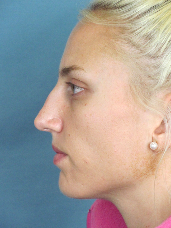 Rhinoplasty Before and After | Thomas Funcik MD