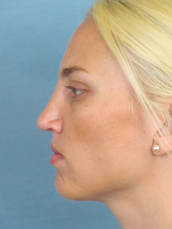 Rhinoplasty Before and After | Thomas Funcik MD