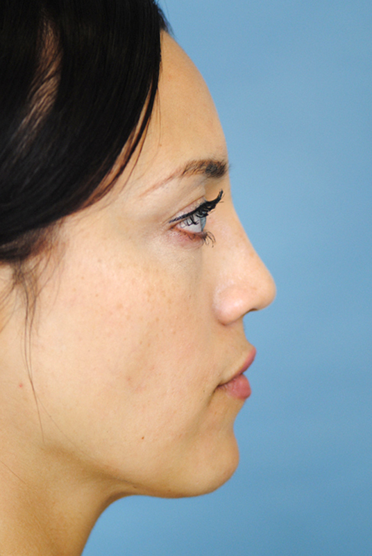 Rhinoplasty Before and After | Thomas Funcik MD