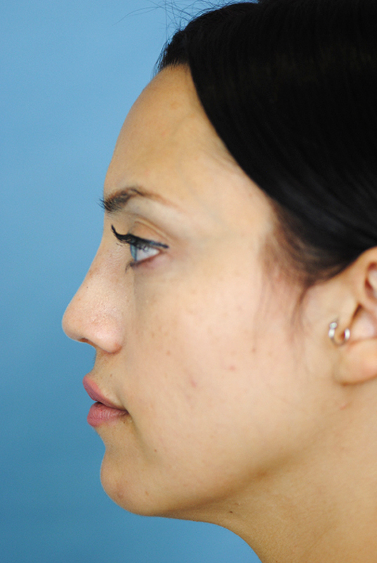 Rhinoplasty Before and After | Thomas Funcik MD