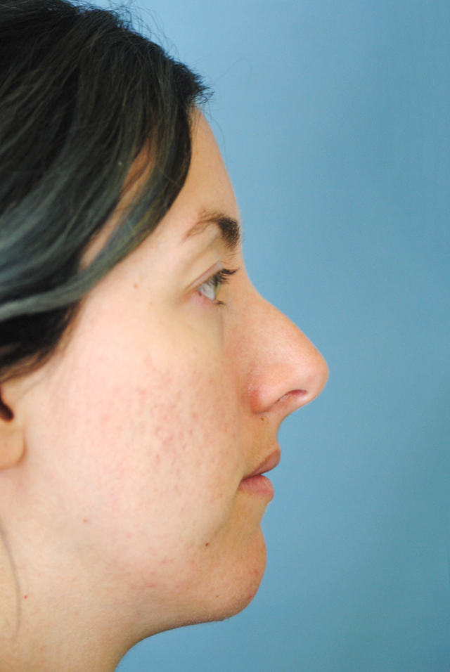 Rhinoplasty Before and After | Thomas Funcik MD