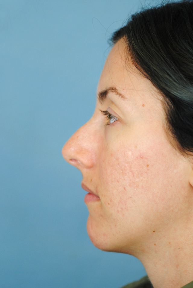 Rhinoplasty Before and After | Thomas Funcik MD