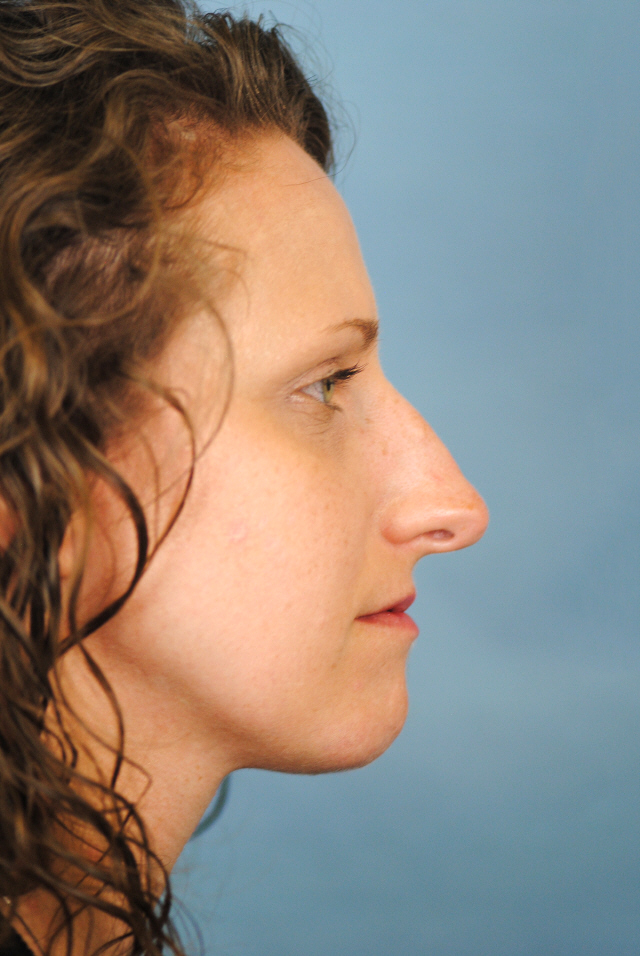 Rhinoplasty Before and After | Thomas Funcik MD