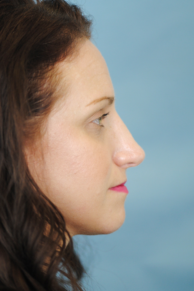 Rhinoplasty Before and After | Thomas Funcik MD