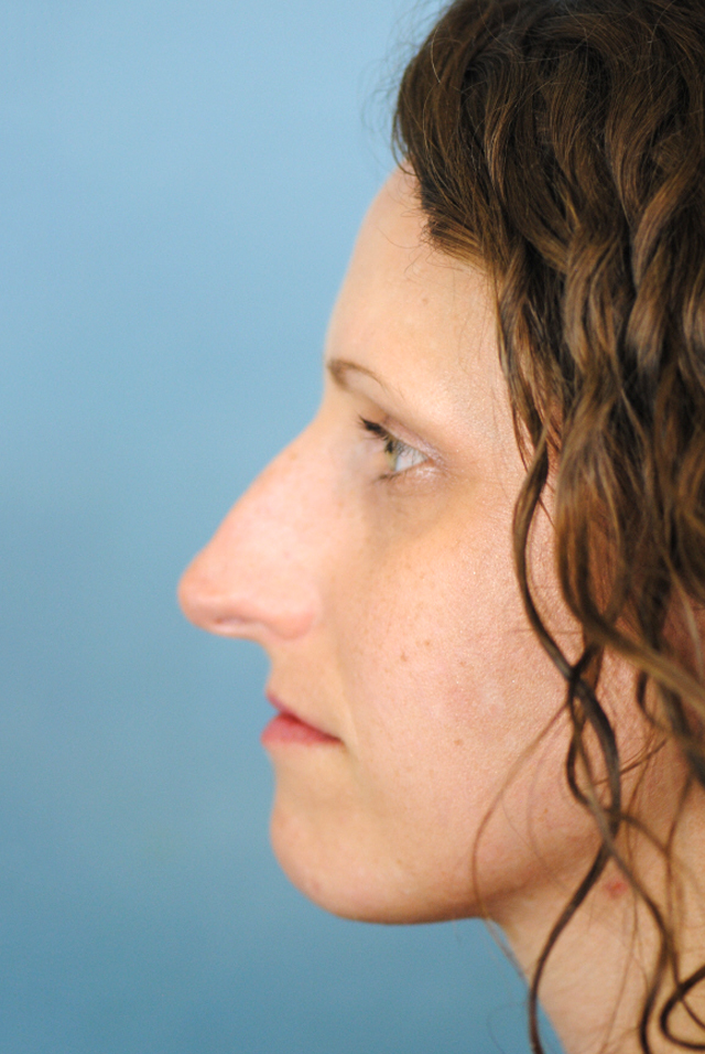 Rhinoplasty Before and After | Thomas Funcik MD