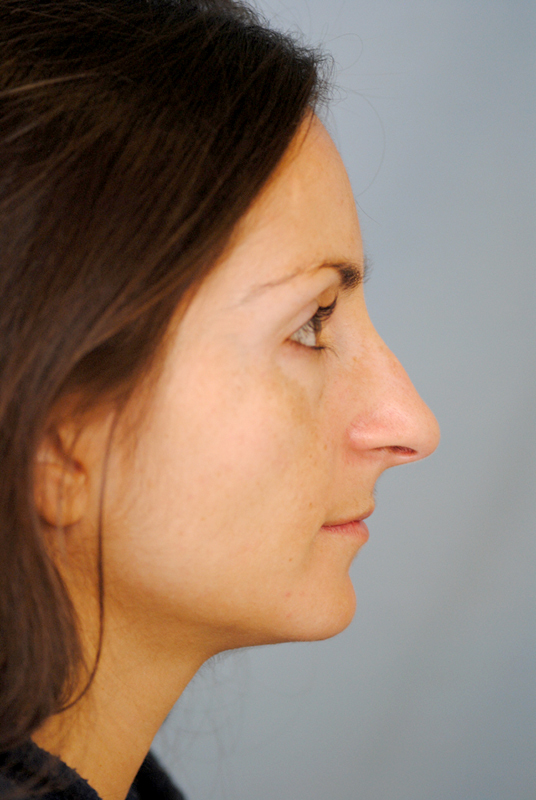 Rhinoplasty Before and After | Thomas Funcik MD