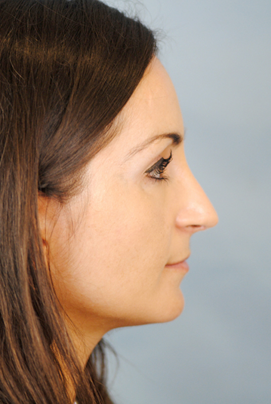 Rhinoplasty Before and After | Thomas Funcik MD