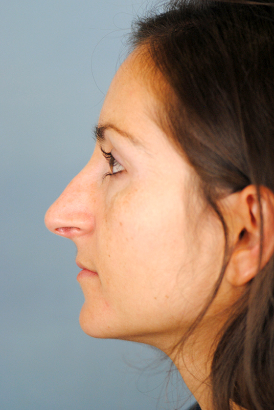 Rhinoplasty Before and After | Thomas Funcik MD