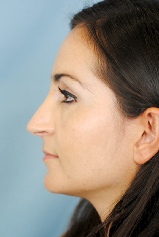 Rhinoplasty Before and After | Thomas Funcik MD