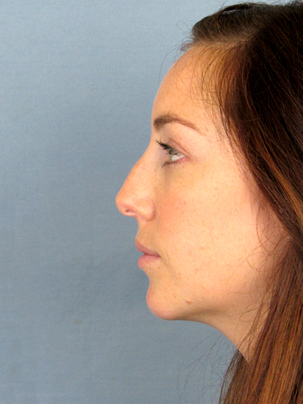 Rhinoplasty Before and After | Thomas Funcik MD