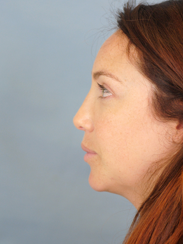 Rhinoplasty Before and After | Thomas Funcik MD