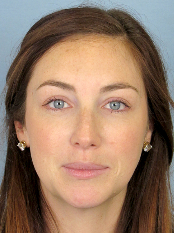 Rhinoplasty Before and After | Thomas Funcik MD