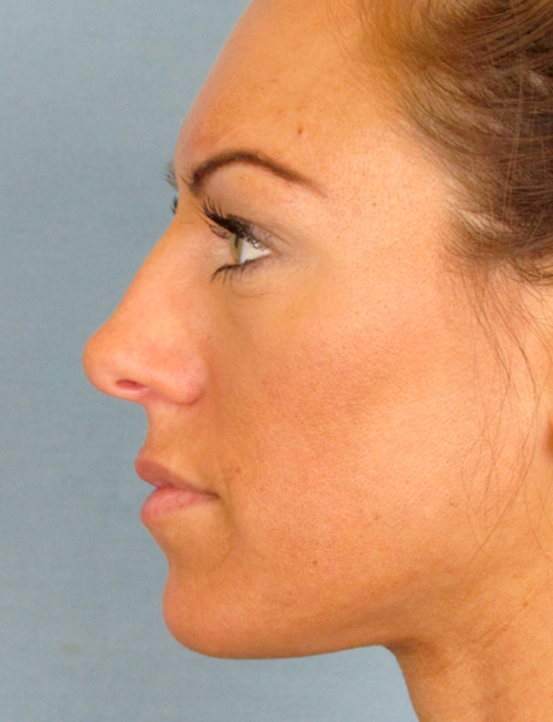 Rhinoplasty Before and After | Thomas Funcik MD