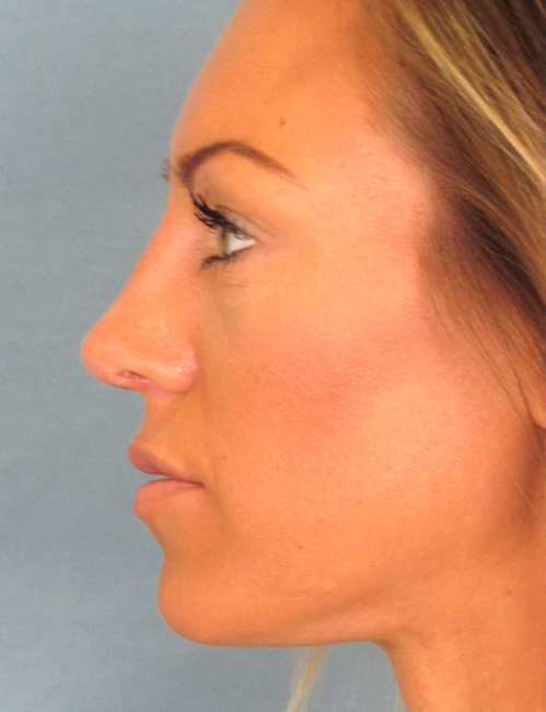 Rhinoplasty Before and After | Thomas Funcik MD