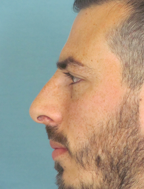 Rhinoplasty Before and After | Thomas Funcik MD