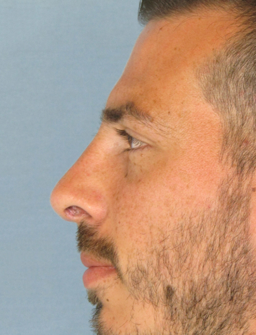 Rhinoplasty Before and After | Thomas Funcik MD