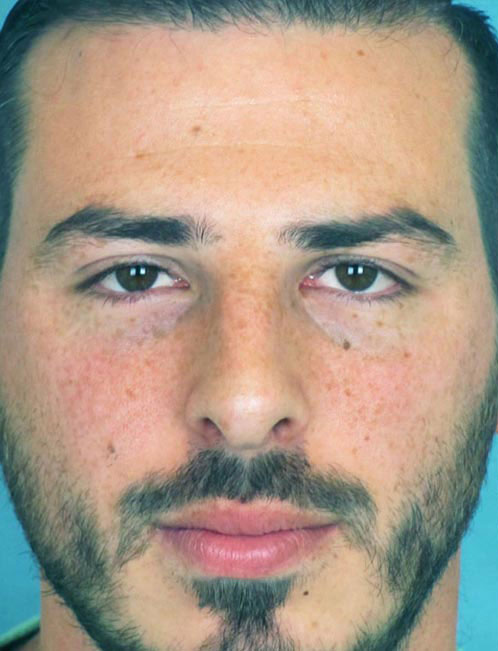 Rhinoplasty Before and After | Thomas Funcik MD