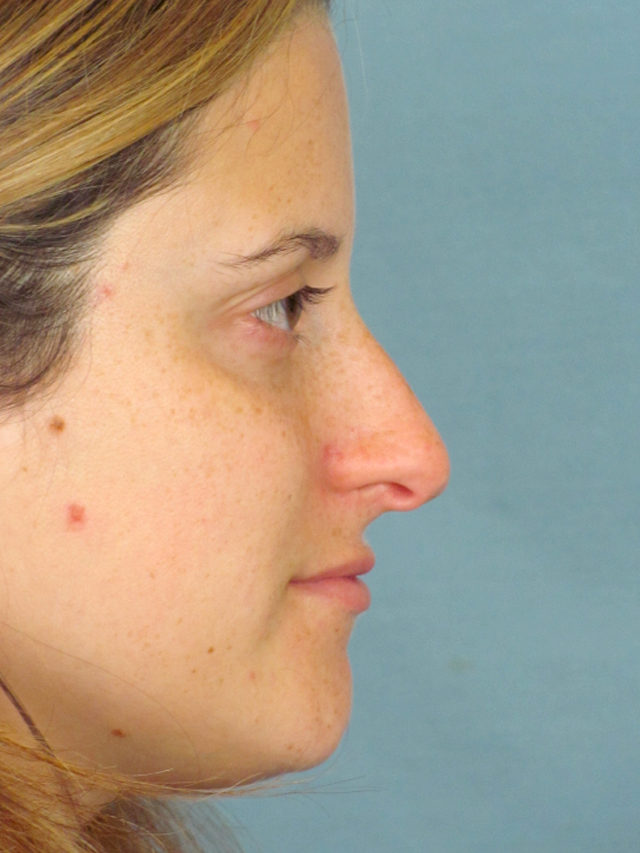 Rhinoplasty Before and After | Thomas Funcik MD