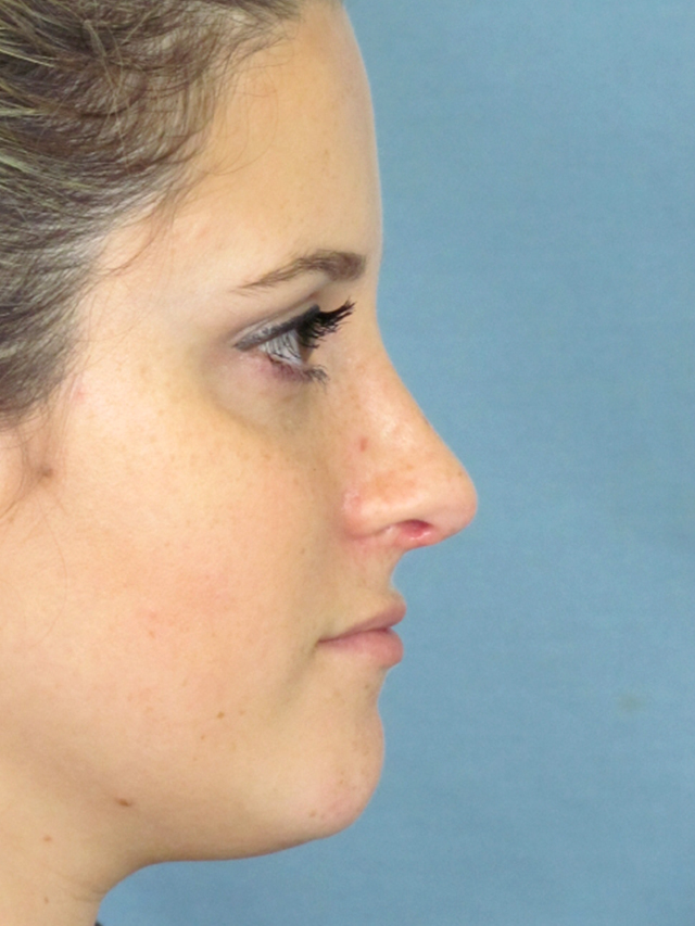 Rhinoplasty Before and After | Thomas Funcik MD