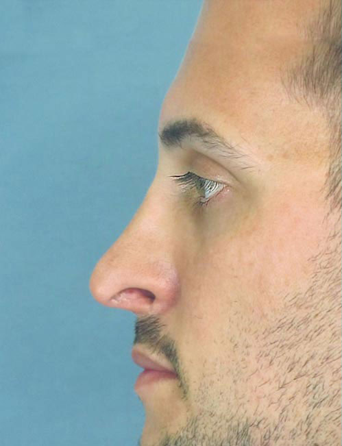 Rhinoplasty Before and After | Thomas Funcik MD