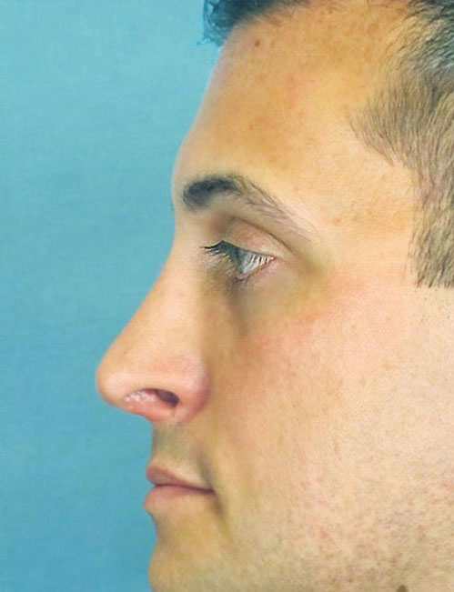 Rhinoplasty Before and After | Thomas Funcik MD