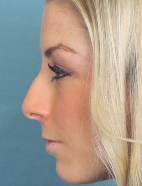 Rhinoplasty Before and After | Thomas Funcik MD