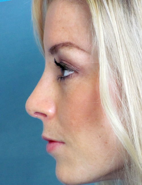 Rhinoplasty Before and After | Thomas Funcik MD