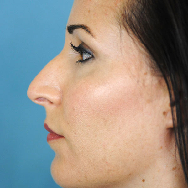 Rhinoplasty Before and After | Thomas Funcik MD